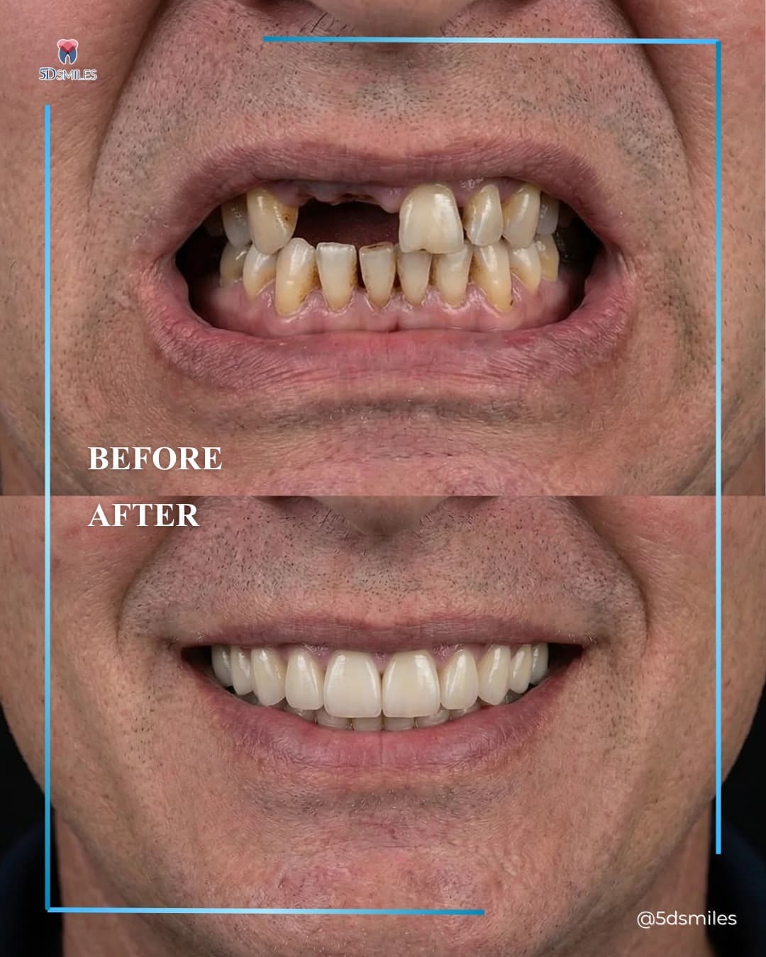 All-on-6 upper arch