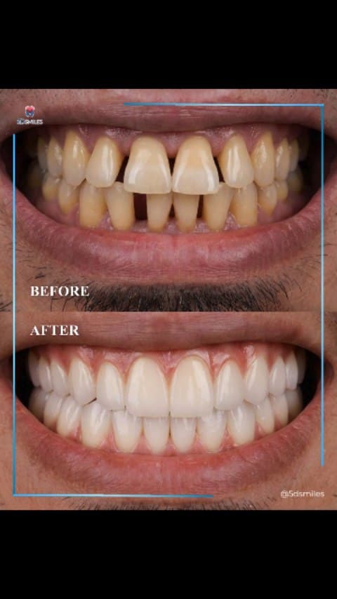 Bone graft + 2 implants