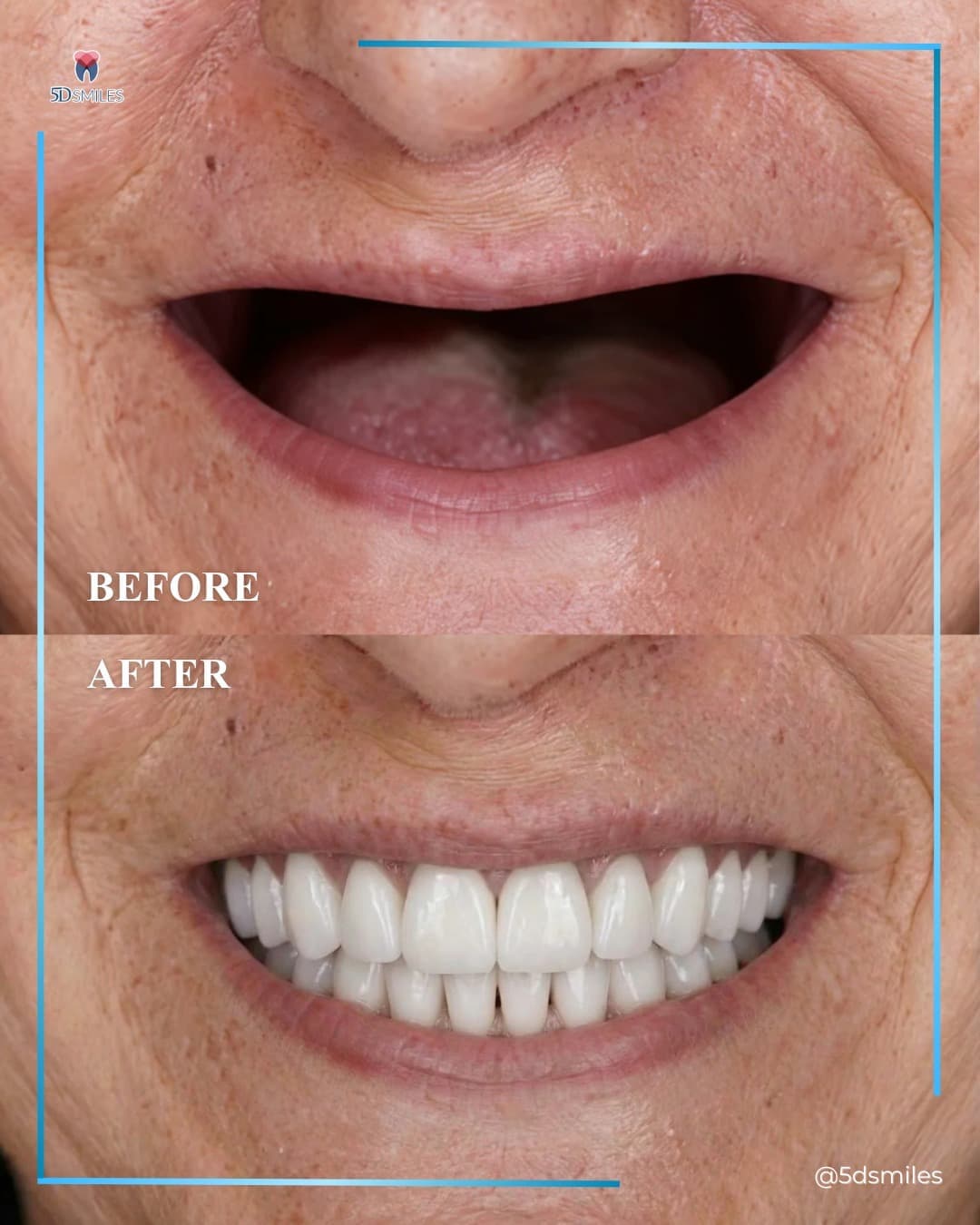 Single molar implant