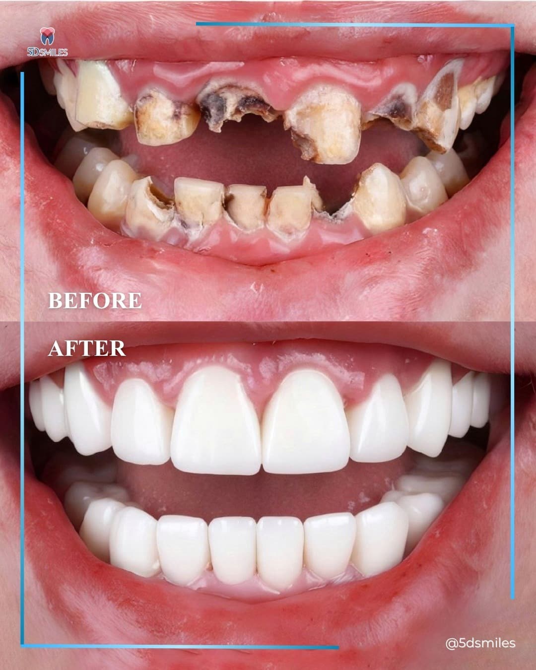 2 implants + sinus lift