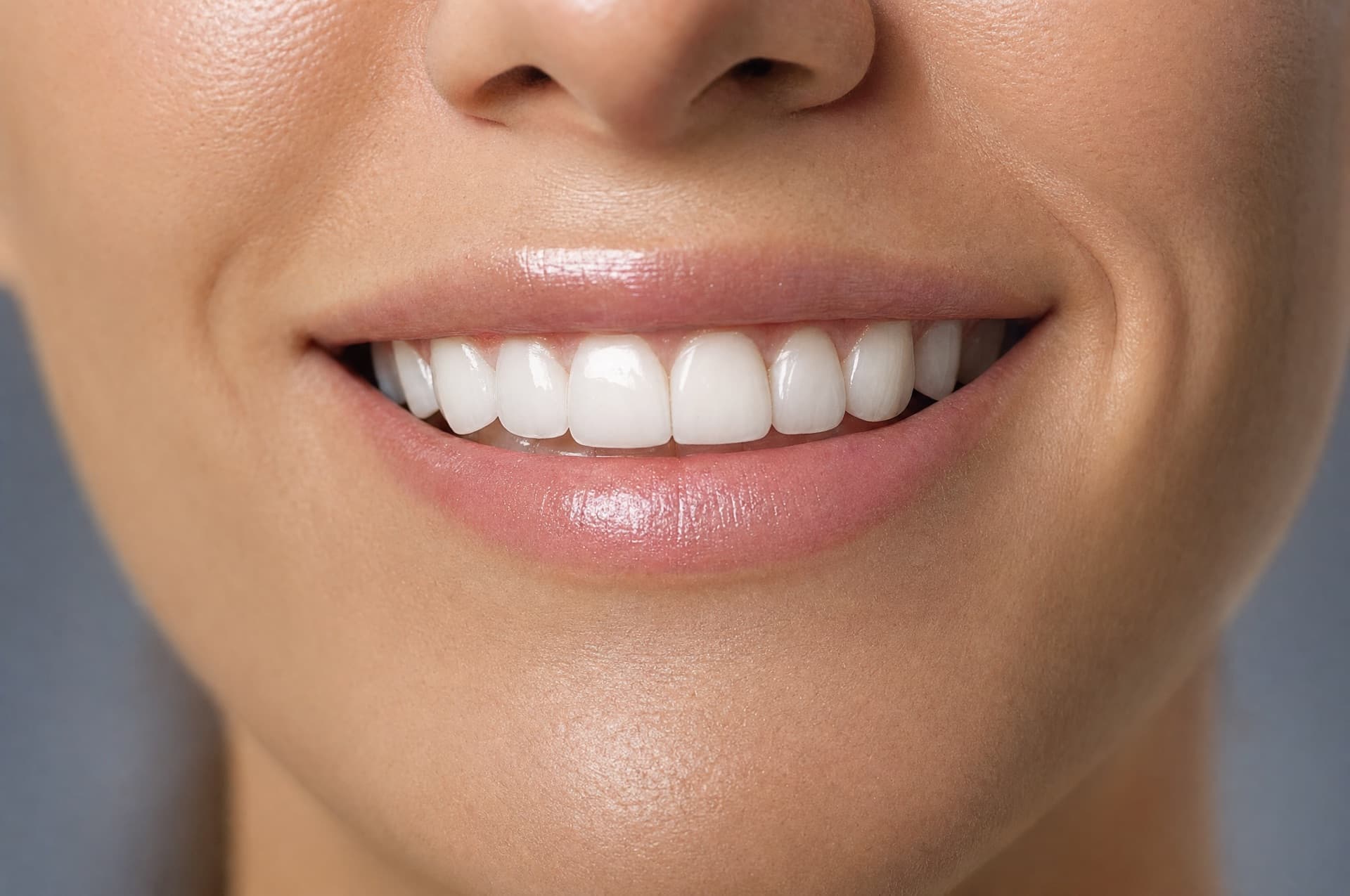 Veneers